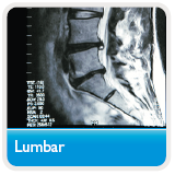 MRI of lumbar spine